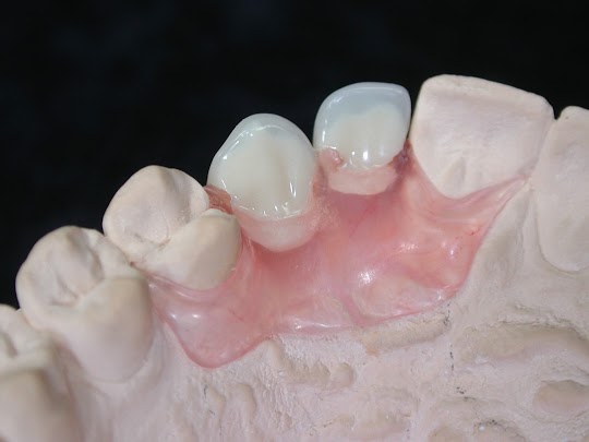 Soluzioni Non Invasive A Impianti Dentali I Ponti Rimovibili